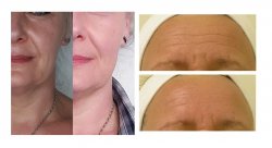 Radiofréquence microneedling